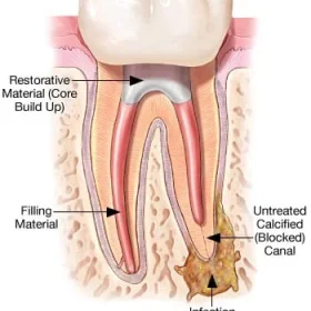 Re-Root Canal Treatment: Why It’s Needed & What Affects Success