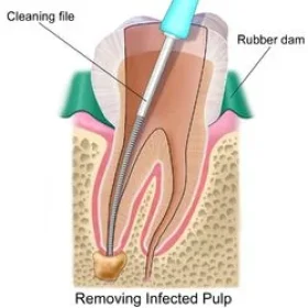 Why You Still Have Pain After Root Canal Treatment