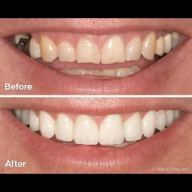 Smile Designing & Veneers: Your Guide to a Confident Smile