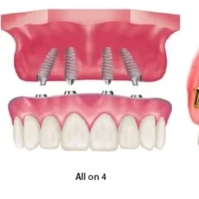 How Many Dental Implants Do You Really Need for Full Mouth Rehabilitation?