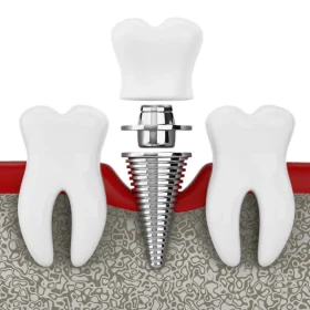 Is Dental Treatment Really Expensive… Or Is Delaying It Making It Expensive?