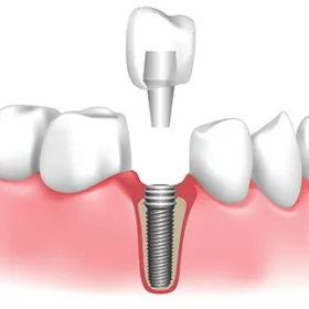 What Questions Should You Ask Before Getting Dental Implants in Pune?